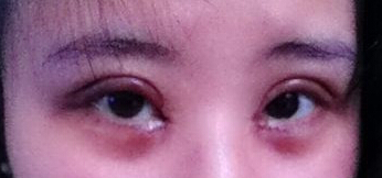 妹子分享：我做双眼皮开眼角后的恢复照 