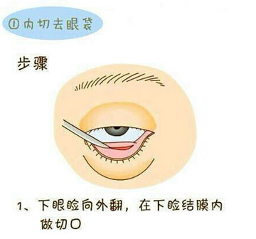 微整形去眼袋过程图