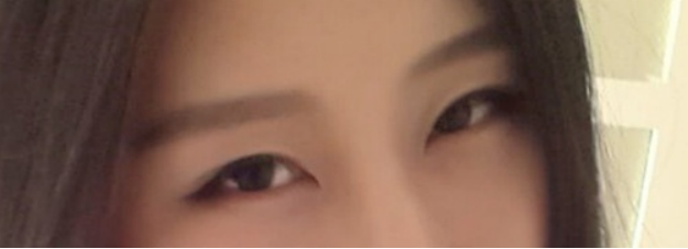 妹子分享切开双眼皮消肿妙招：敷土豆片！