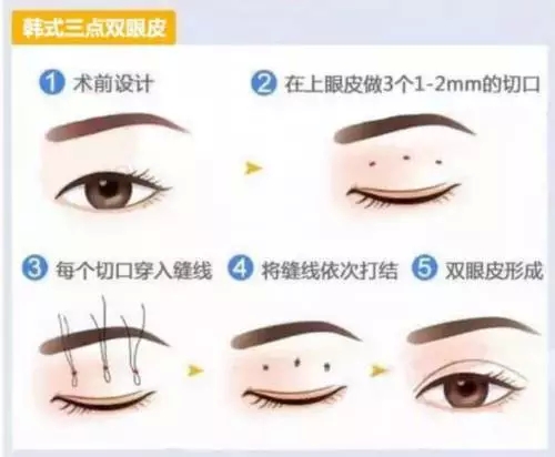 双眼皮可以开眼角吗？牛头不对马嘴