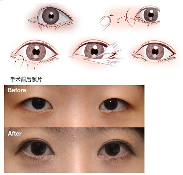 开眼角是什么原理？来看简单介绍