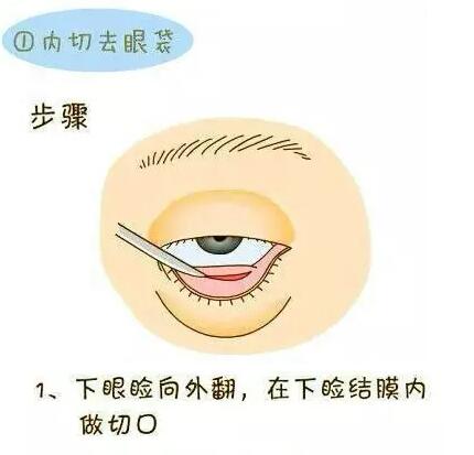 想要去眼袋？先了解眼袋整形术过程！