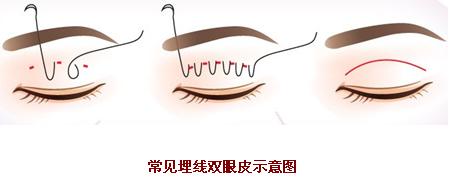 男士埋线双眼皮手术 轻轻松松智慧加分