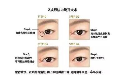 开内眼角有哪些方法？这三种最常见！