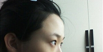 埋线双眼皮前的状况