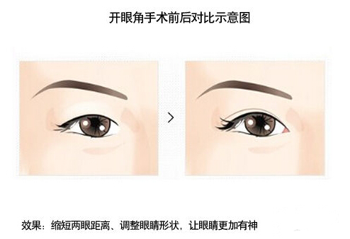 开眼角是什么意思？正确认识开眼角