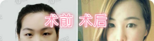 美丽分享：韩式双眼皮手术对比照片
