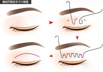 埋线双眼皮如何修复?专家为你解答!