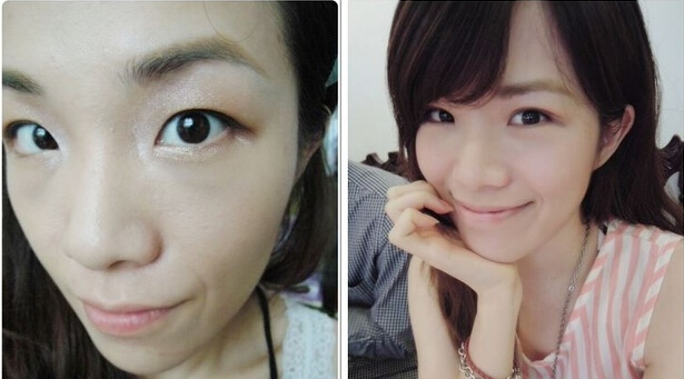 讲述：我做切开双眼皮术后消肿超快！