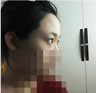 埋线双眼皮恢复