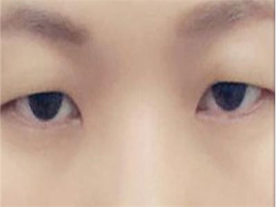 如何才能改善上睑下垂矫正