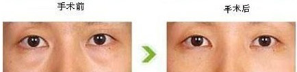祛眼袋的术前术后对比照