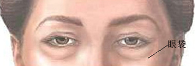 眼袋使人显老