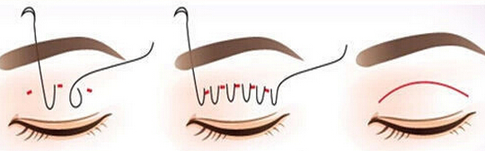 韩式双眼皮需要拆线吗？