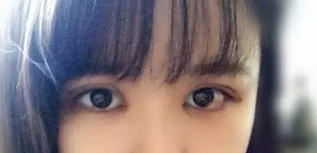 开眼角加双眼皮后 我变身萌妹纸一枚!