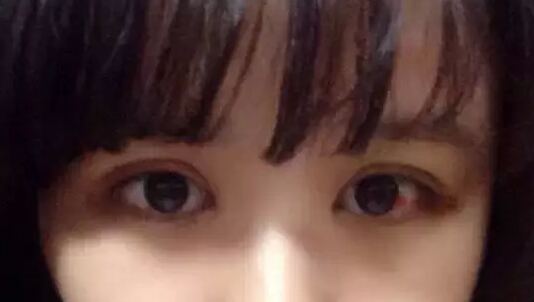 开眼角加双眼皮后 我变身萌妹纸一枚!