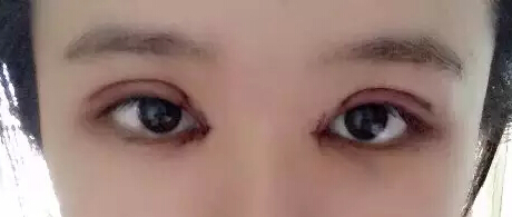 开眼角加双眼皮后 我变身萌妹纸一枚!