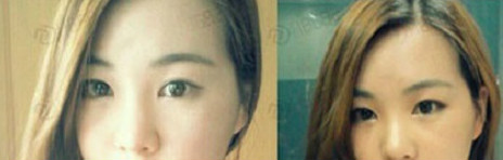 真实案例：韩式双眼皮手术恢复记录