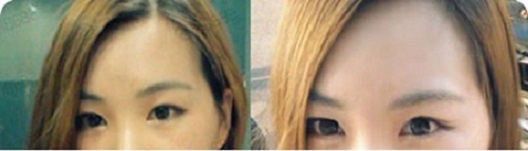 真实案例：韩式双眼皮手术恢复记录