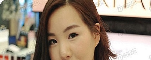 真实案例：韩式双眼皮手术恢复记录
