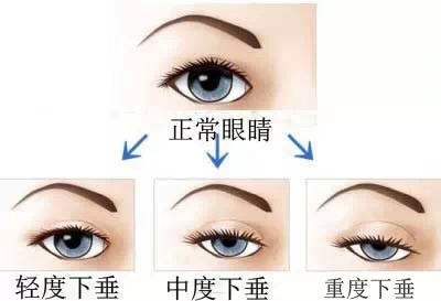 双眼皮贴的危害1、眼皮下垂