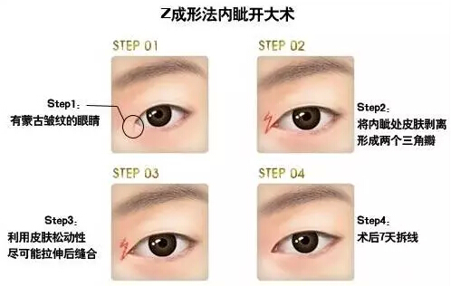 开眼角有几种方法？来看大盘点！