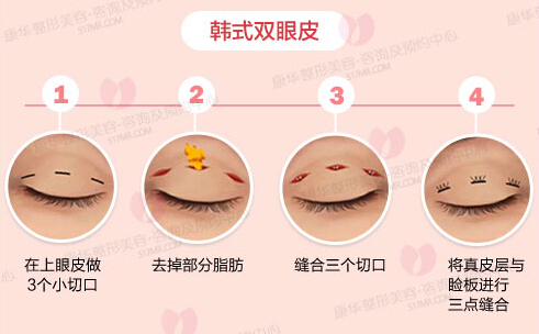 韩式双眼皮