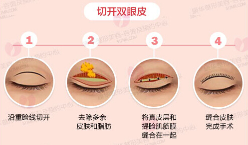 切开双眼皮