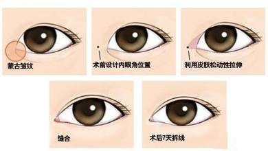 开眼角手术过程