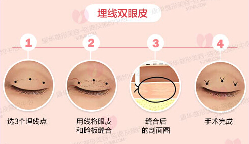埋线双眼皮