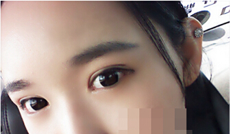 埋线双眼皮术后照片 第三天情况