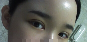 埋线双眼皮术后照片 当天情况