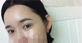 埋线双眼皮术后照片 第五天情况