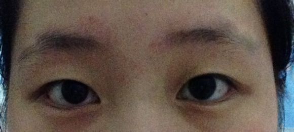 妹子分享：看我的韩式双眼皮前后对比如何？