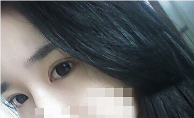 埋线双眼皮术后照片 第七天情况