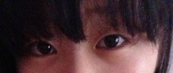 妹子分享：看我的韩式双眼皮前后对比如何？