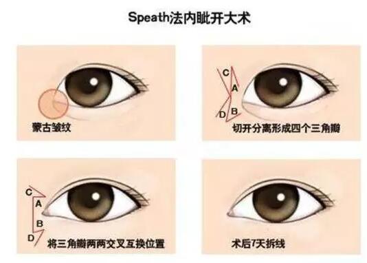 开内眼角有哪些方法？这三种最常见！