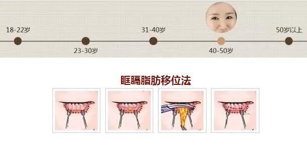 去眼袋方法详细介绍 你是哪个年龄段？