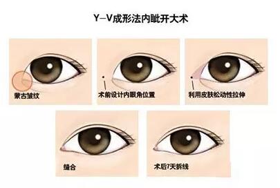 开内眼角有哪些方法？这三种最常见！