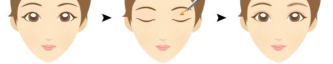 韩式双眼皮手术对比