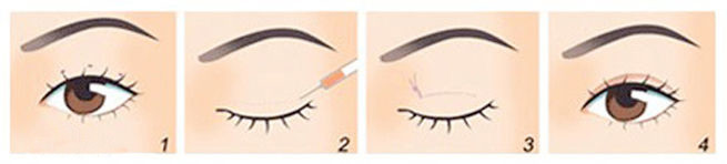 韩式双眼皮手术对比