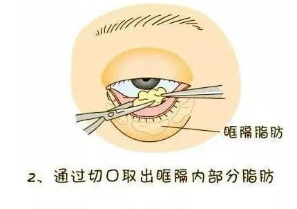 想要去眼袋？先了解眼袋整形术过程！