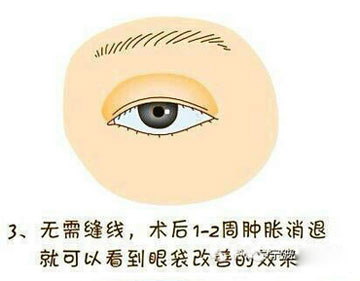 眼袋美容术过程 一张图告诉你！