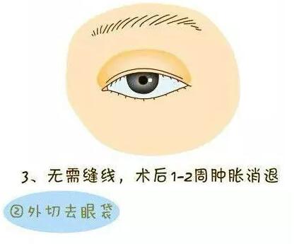 想要去眼袋？先了解眼袋整形术过程！