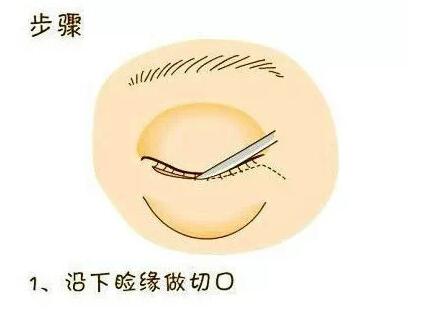 想要去眼袋？先了解眼袋整形术过程！