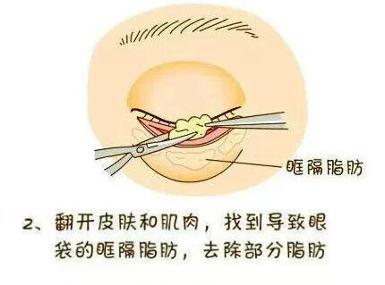 想要去眼袋？先了解眼袋整形术过程！