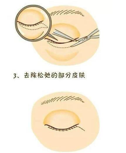 想要去眼袋？先了解眼袋整形术过程！