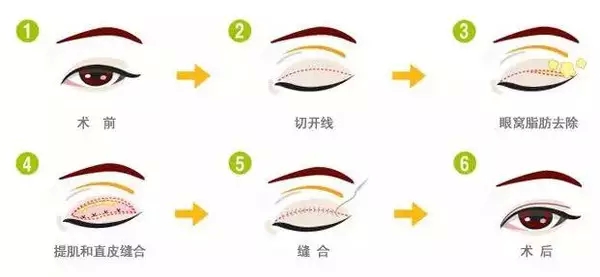 双眼皮可以开眼角吗？牛头不对马嘴