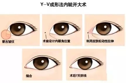 双眼皮可以开眼角吗？牛头不对马嘴