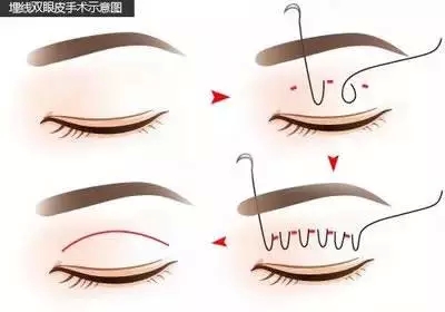 双眼皮可以开眼角吗？牛头不对马嘴